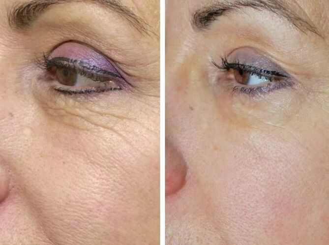 Veldlaser voor en na